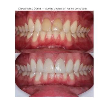 Clareamento Dental na Vila maria